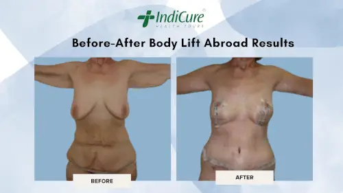 Before-After Body Lift Abroad Results Before-After Body Lift Abroad Results